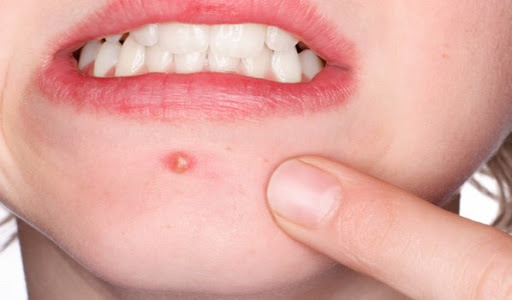 Le masque qui élimine les boutons et les traces d’acné