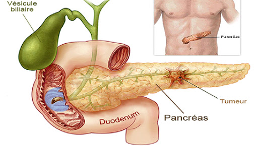 Deux chimiothérapies combinées prolongeant la vie de certains malades