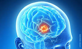 Tumeurs du cerveau: des ultrasons pour faciliter la diffusion du traitement