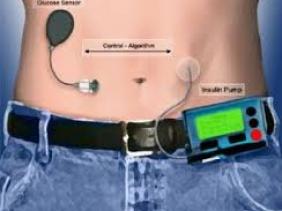 Un pancréas artificiel pour diabétiques associant smartphone et insuline