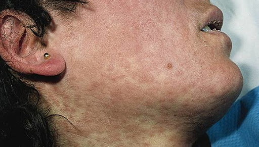 El Bayadh : trois cas de rougeole enregistrés et des mesures préventives entreprises