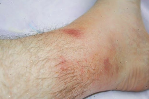 Aïn Témouchent: 13 cas de fièvre méditerranéenne familiale