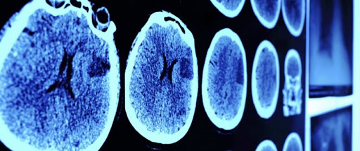 Alzheimer : des chercheurs évoquent la piste des anti-inflammatoires