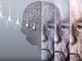 Alzheimer : résultats préliminaires prometteurs d&rsquo;un nouveau traitement
