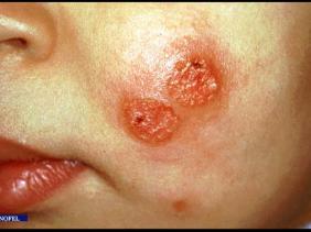 Tébessa : 498 cas de brucellose et 156 de leishmaniose enregistrés depuis le début de l’année