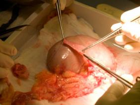 Néphrologie : la 102 ème greffe rénale effectuée avec succès au CHU Batna