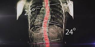 Malades atteints de scoliose: Bientôt un atelier de fabrication de corsets à Oran