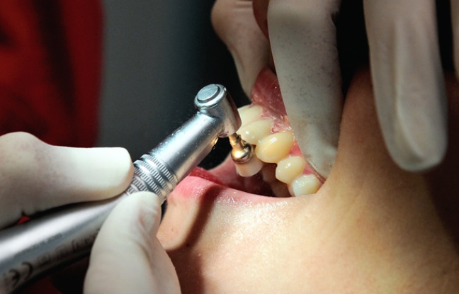 Caries: Un médicament contre Alzheimer pour soigner les dents?