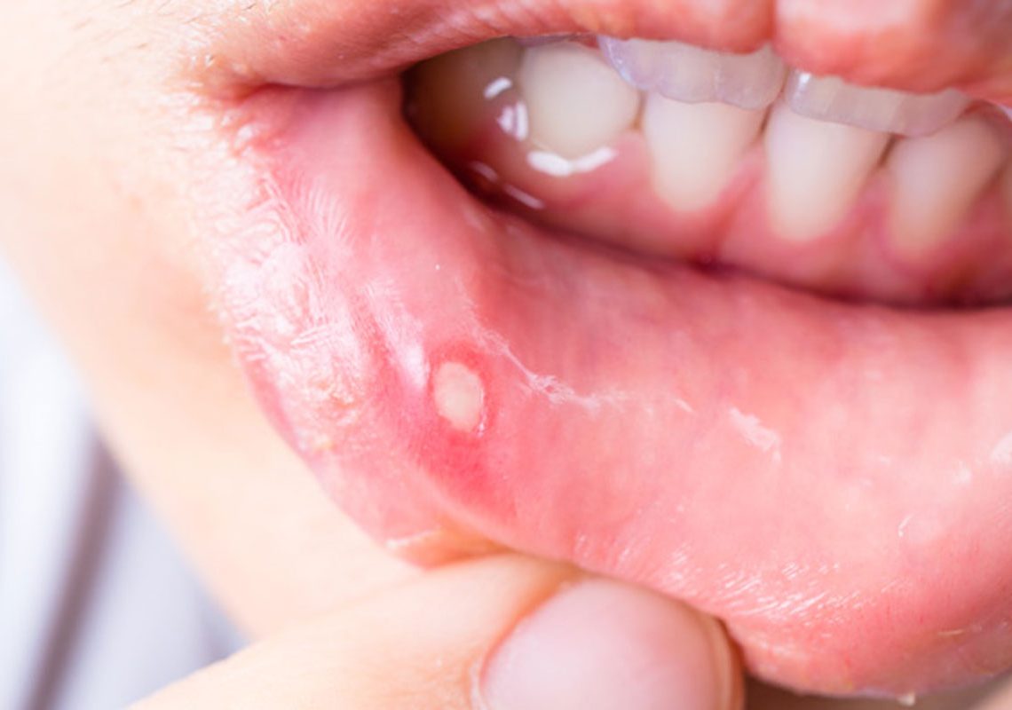3 Astuces naturelles pour se débarrasser des aphtes buccaux