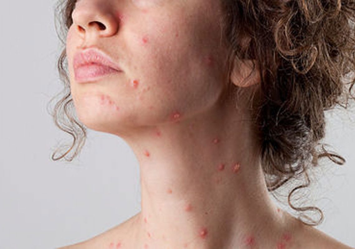 Tout savoir sur la varicelle