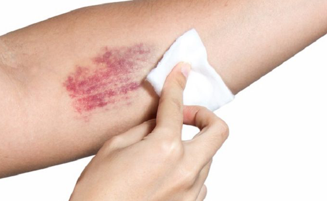 Comment faire disparaître un bleu naturellement ?