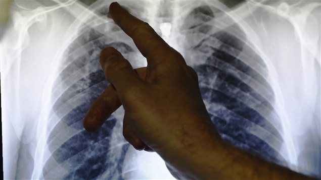 Tuberculose : 22.000 cas en Algérie en 2016