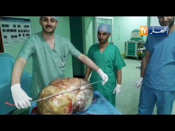 Tissemsilt: Ablation d’un énorme kyste ovarien pesant plus de 37 kilos
