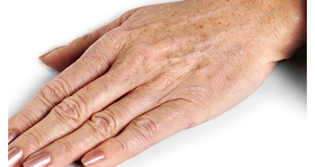 Beauté:  Taches de vieillesse, explications et astuces