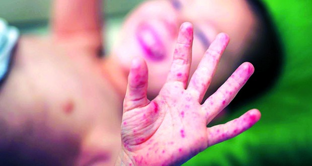 Ouargla: 16 cas de rougeole enregistrés depuis le début de l’année