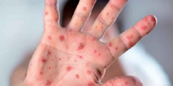 Ouargla: baisse continue des cas de rougeole