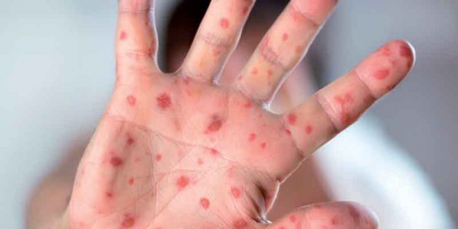 Plus de 2.300 cas de rougeole recensés dans 13 wilayas, 5 décès