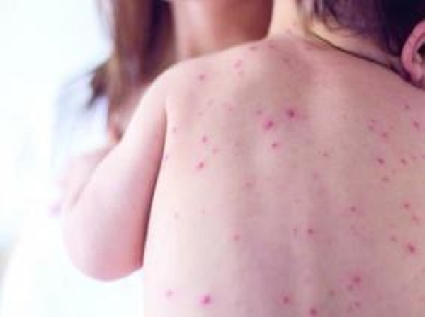Blida : hausse des cas de suspicion de rougeole à 60