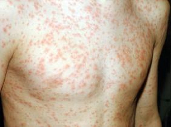 4 181 cas de rougeole enregistrés au niveau national jusqu&rsquo;à samedi