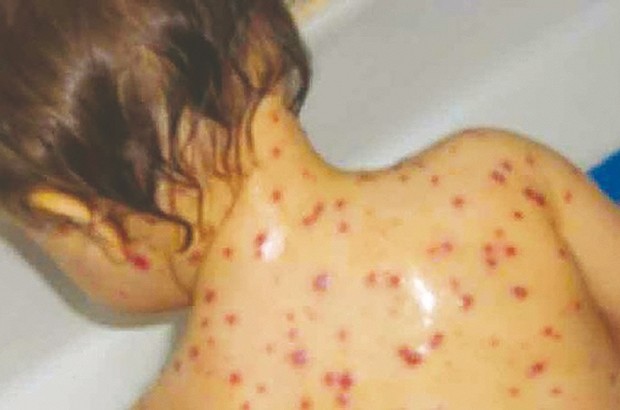 DÉCÈS D’UNE FEMME DE 45 ANS : La rougeole fait une nouvelle victime à El-Oued