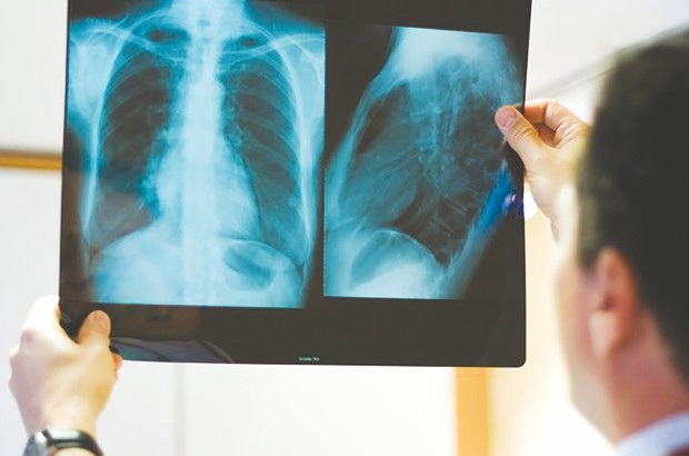 La tuberculose extra-pulmonaire en progression !