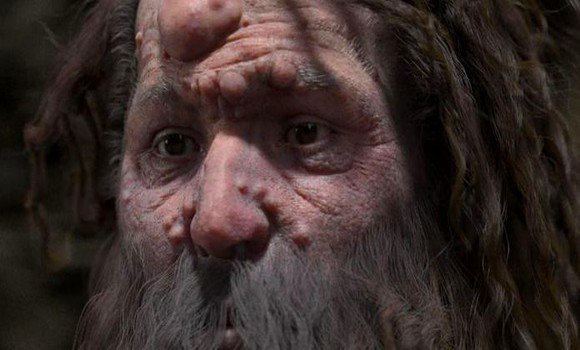 L’homme de Cro-Magnon avait le visage couvert de nodules