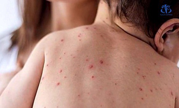 Santé : 4 181 cas de rougeole enregistrés au niveau national jusqu&rsquo;à samedi