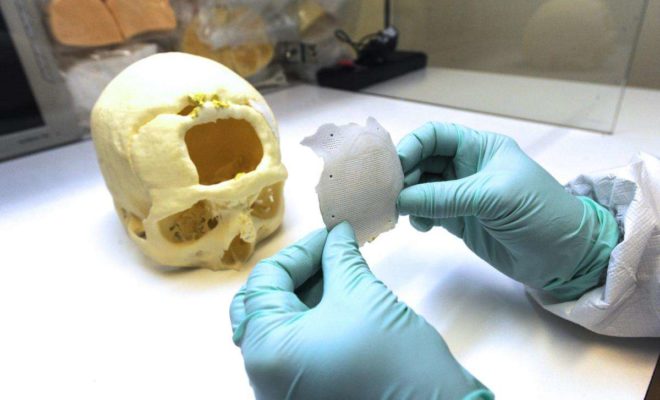 Première prothèse crânienne 3D 100% algérienne