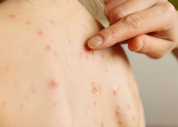 La rougeole fait sa cinquième victime dans la Wilaya d’El Oued