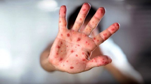 Rougeole: 6.438 cas enregistrés dans 29 wilayas, 9 décès