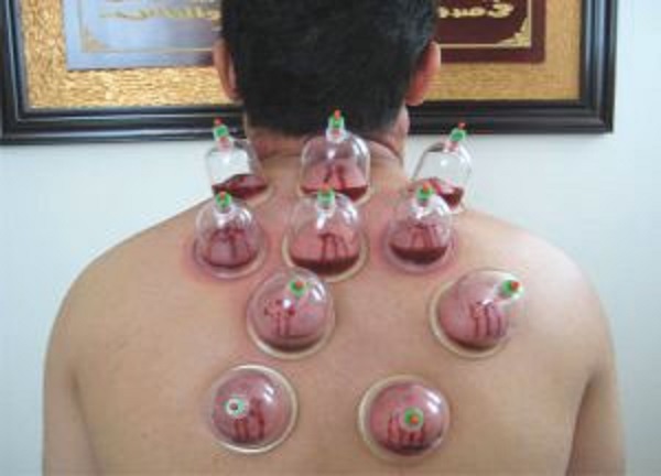 Pratique d’El Hidjama à Bordj Bou-Arréridj : Les spécialistes tirent la sonnette d’alarme