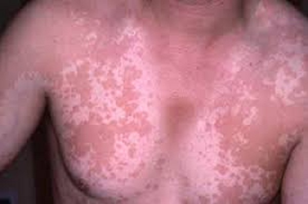 Solutions naturelles contre le pityriasis rosé