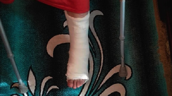 Une fonctionnaire chute dans un trou et se fracture la cheville