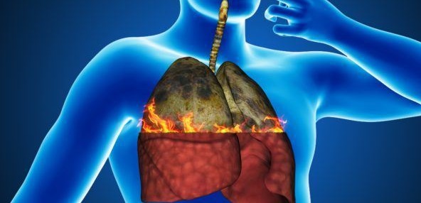 L’élimination d’un gène clé peut inhiber le cancer du poumon