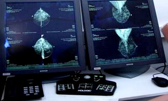 Cancer du sein: 1ère étude à grande échelle pour personnaliser le dépistage