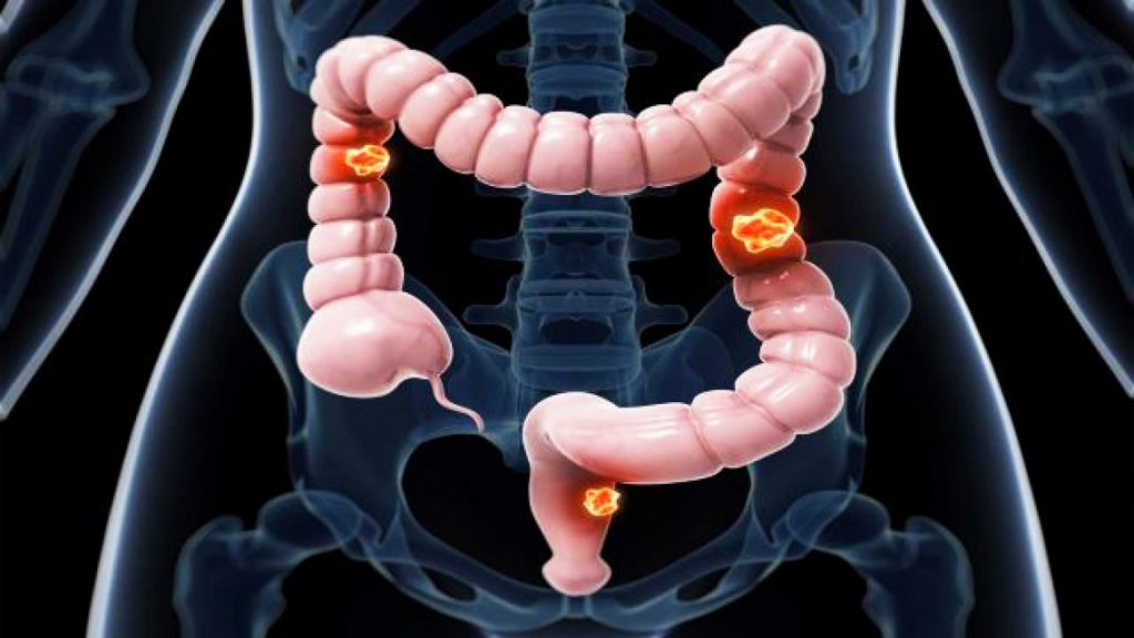 Le dépistage précoce pour diminuer la fréquence des cancers colorectaux en Algérie
