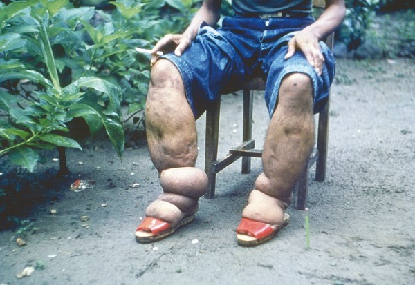 Solidarité avec les victimes d’éléphantiasis : Les trois galas prévus en octobre annulés