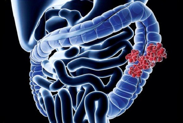 Congrès international sur « l&rsquo;oncologie digestive » le 6 décembre à Oran