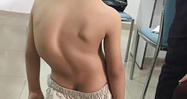 Scoliose de l’enfant à Oran : Le dépistage précoce mis en relief