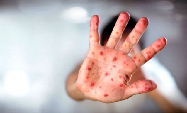 Des cas sporadiques de rougeole encore notifiés dans certaines wilayas