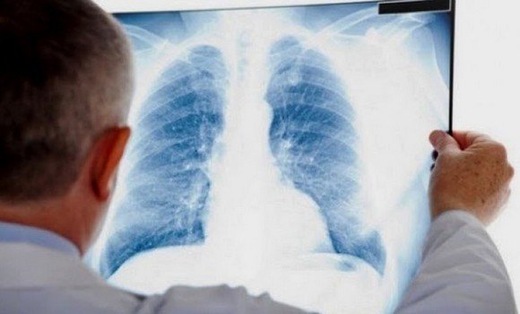 Baisse annuelle de 4,4% des cas de tuberculose dans les wilayas de l’Ouest