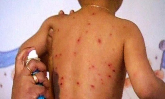 Ghardaïa: 26 cas de rougeole enregistrée récemment à Guerrara
