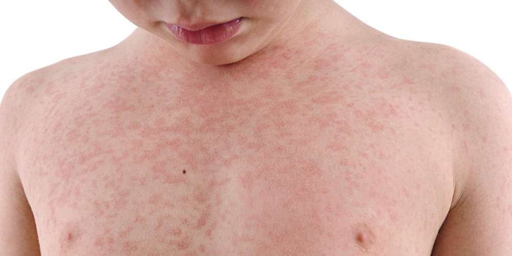 La rougeole tue un bébé de 18 mois à Jijel