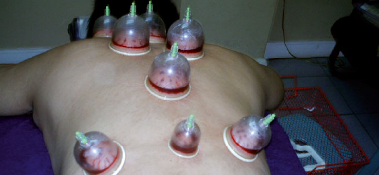 Ouargla : El-Hijama, une thérapie traditionnelle qui a de plus en plus d&rsquo;adeptes