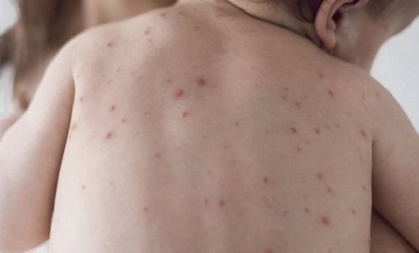 Plus de 10.000 cas de rougeole enregistrés à travers le pays depuis début 2019