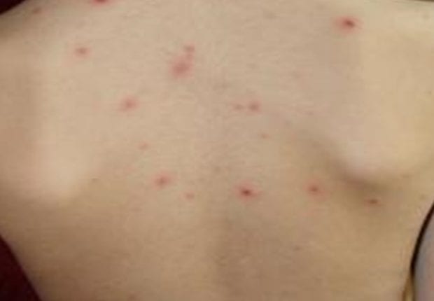 Maladie de gale : 200 cas confirmés dans une école primaire à Bouira