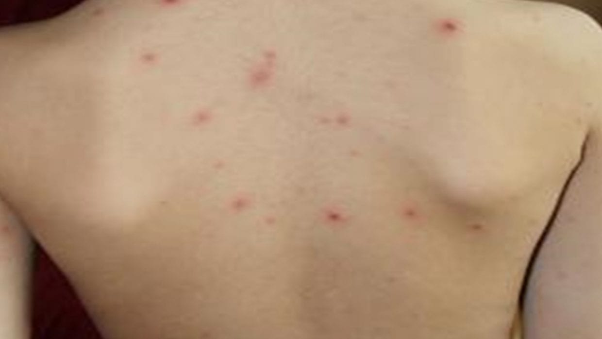 Maladie de gale : 200 cas confirmés dans une école primaire à Bouira