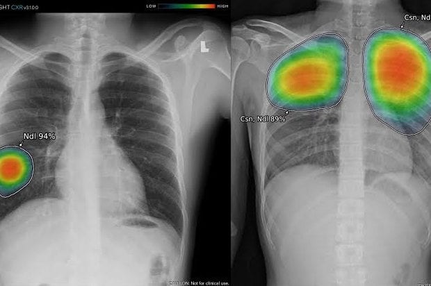 GE Healthcare lance une nouvelle solution d’intelligence artificielle permettant de détecter des anomalies sur les radiographies thoraciques, incluant la pneumonie causée par  la covid-19 et la tuberculose