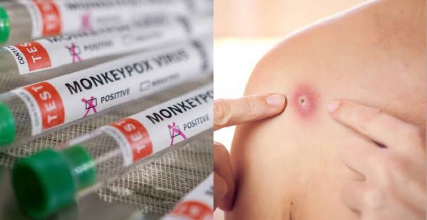 La variole du signe, c’est quoi ? Est-elle dangereuse et mortelle ?
