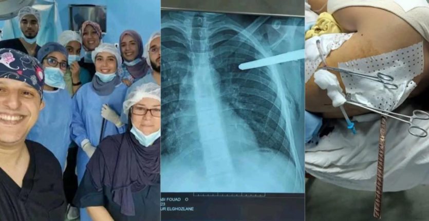 L’équipe médicale du CHU Mustapha sauve un adolescent transpercé par une barre métallique (IMAGES)